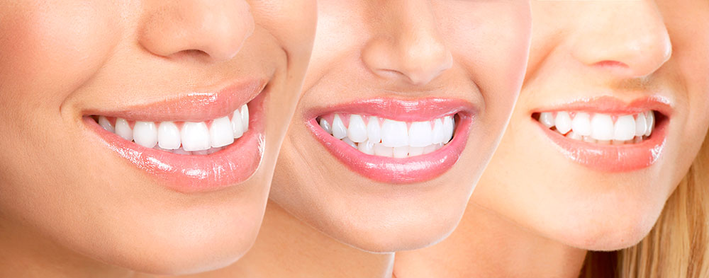 mitos-blanqueamiento-dental