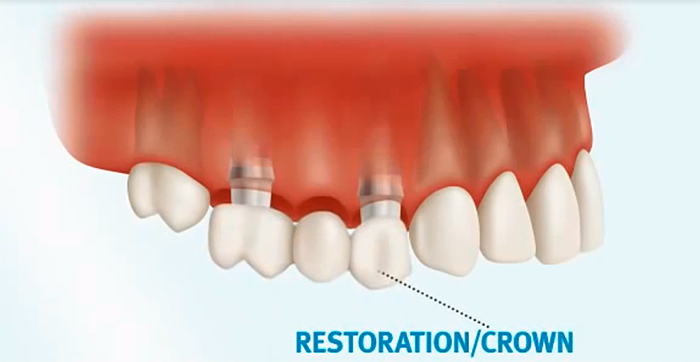 Dental-Bridges