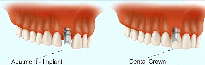 Dental-Crown-Implant