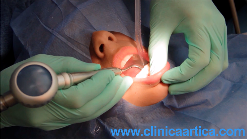 Limpieza-Dental-Ultrasonica-1