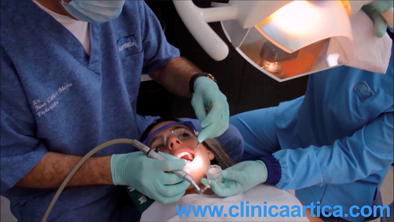 Limpieza-dental-ultrasonica