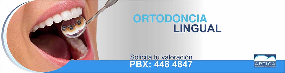 Ortodoncia-Lingual-Medellin