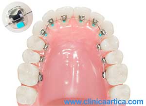 Ortodoncia-Lingual-brackets