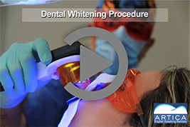 Dental-Whitening-Procedure