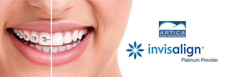 Invisalign