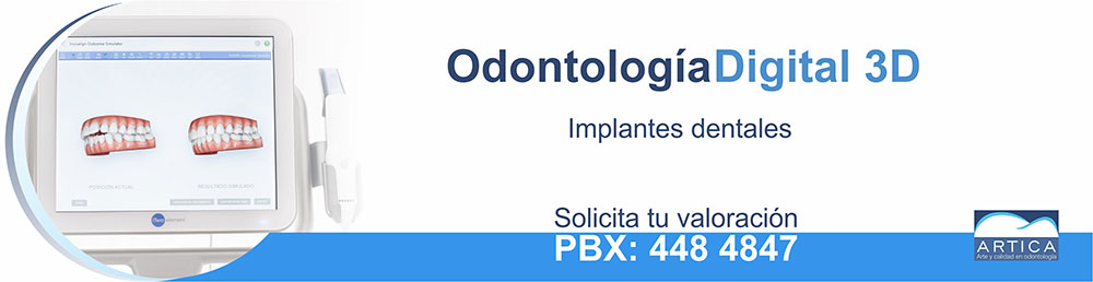 Implantes-dentales-3D