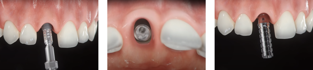 Implantes dentales en Medellin