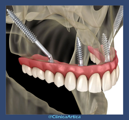Implantes-cigomaticos-medellin-1