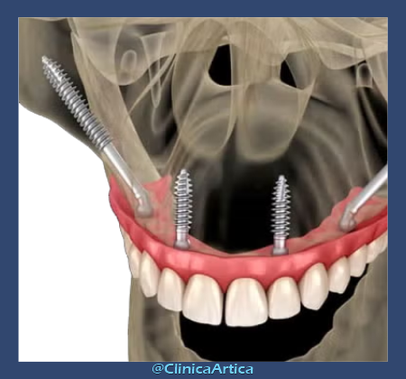 Implantes-cigomaticos-medellin-2