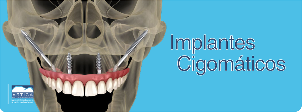 Implantes-cigomaticos-medellin