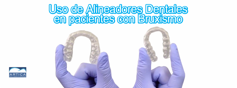 Uso de Alineadores dentales con bruxismo