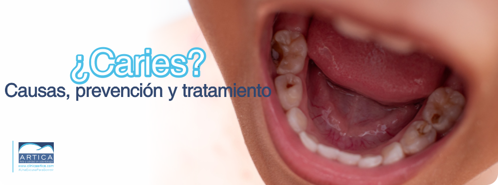 Caries dental 4