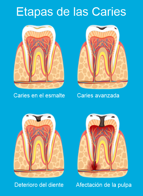Etapas de la caries dental