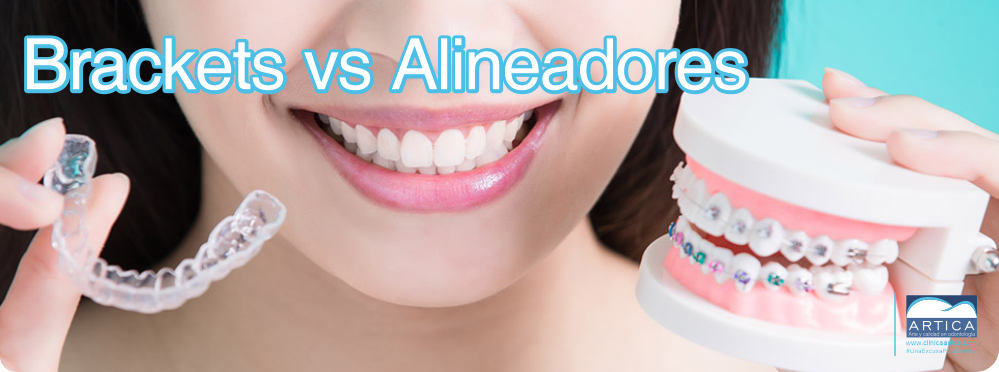 Brackets vs alineadores