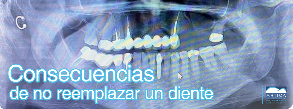 Consecuencias de no reemplazar un diente