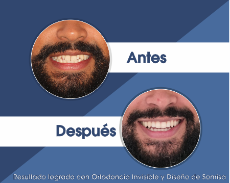 Carillas dentales medellin 3