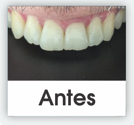 Carillas dentales medellin 6