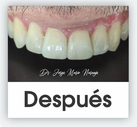 Carillas dentales medellin 7